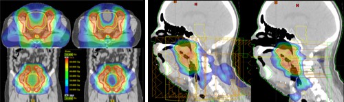 Srovnání ozařovacích plánů IMRT (vlevo) a RapidArc (vpravo)
