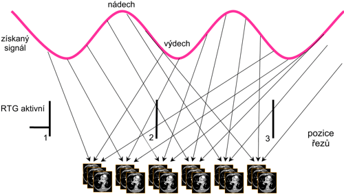 Princip Respiratory Tracking plánování