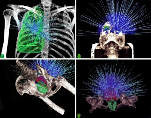 Příklady několika různých stereotaktických ozařovacích plánů přístroje CyberKnife